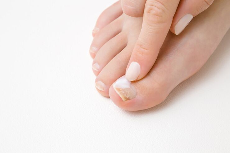 ayak parmaklarının mantar için merhem ile tedavisi