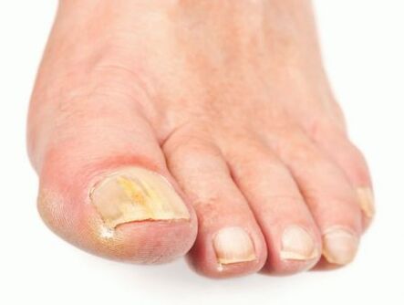 ayaklarda mantar bulunan tırnaklarda hasar