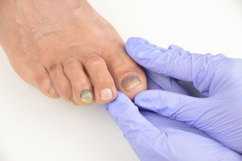 Mantardan etkilenen ayak tırnaklarının tıbbi muayenesi