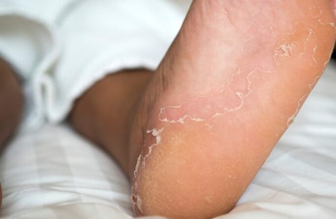 tırnak mantarı ile ayak enfeksiyonları